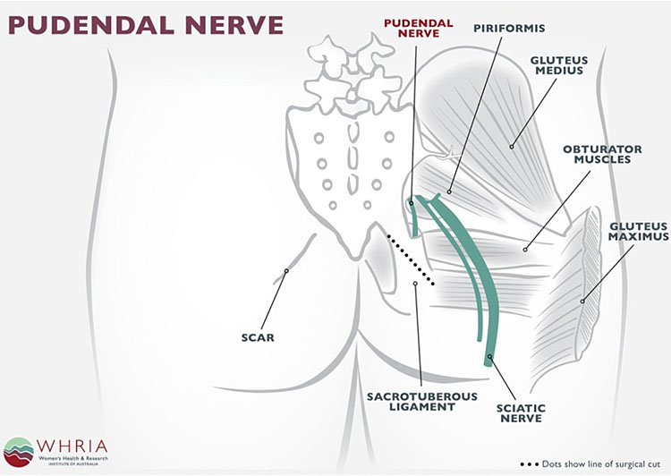 Pudendal and Other Nerve Damage - Posterior Femoral Cutaneous, Ileoinguinal  and Obturator in the Transvaginal Mesh Patient