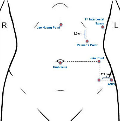 First port placement - Port placement in minimally invasive