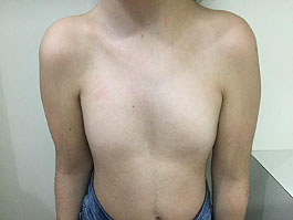 Breast Disorders in Pediatric and Adolescent Patients, Article