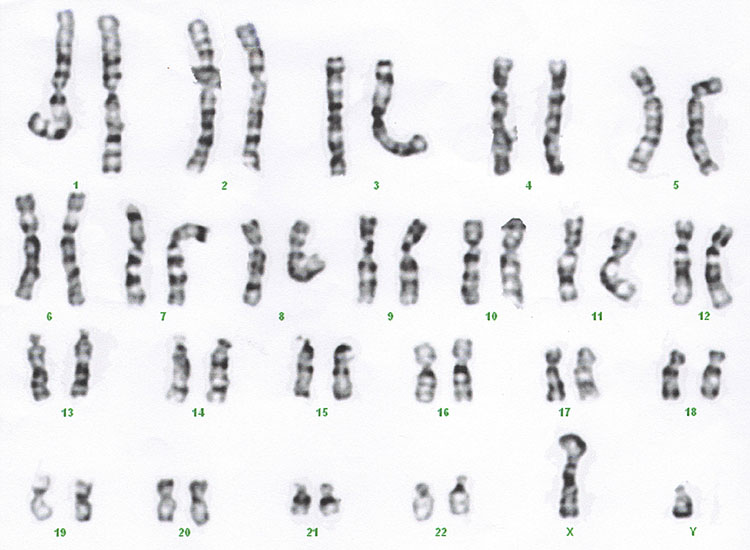 achondroplasia karyotype chromosome 4
