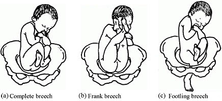 majority of fetal presentation will be