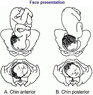 majority of fetal presentation will be