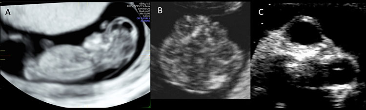 anencephaly ultrasound findings
