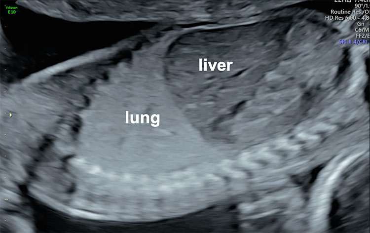 Ultrasound Evaluation Of The Fetal Thorax Article GLOWM Ultrasound Evaluation Of The Fetal Thorax Article GLOWM