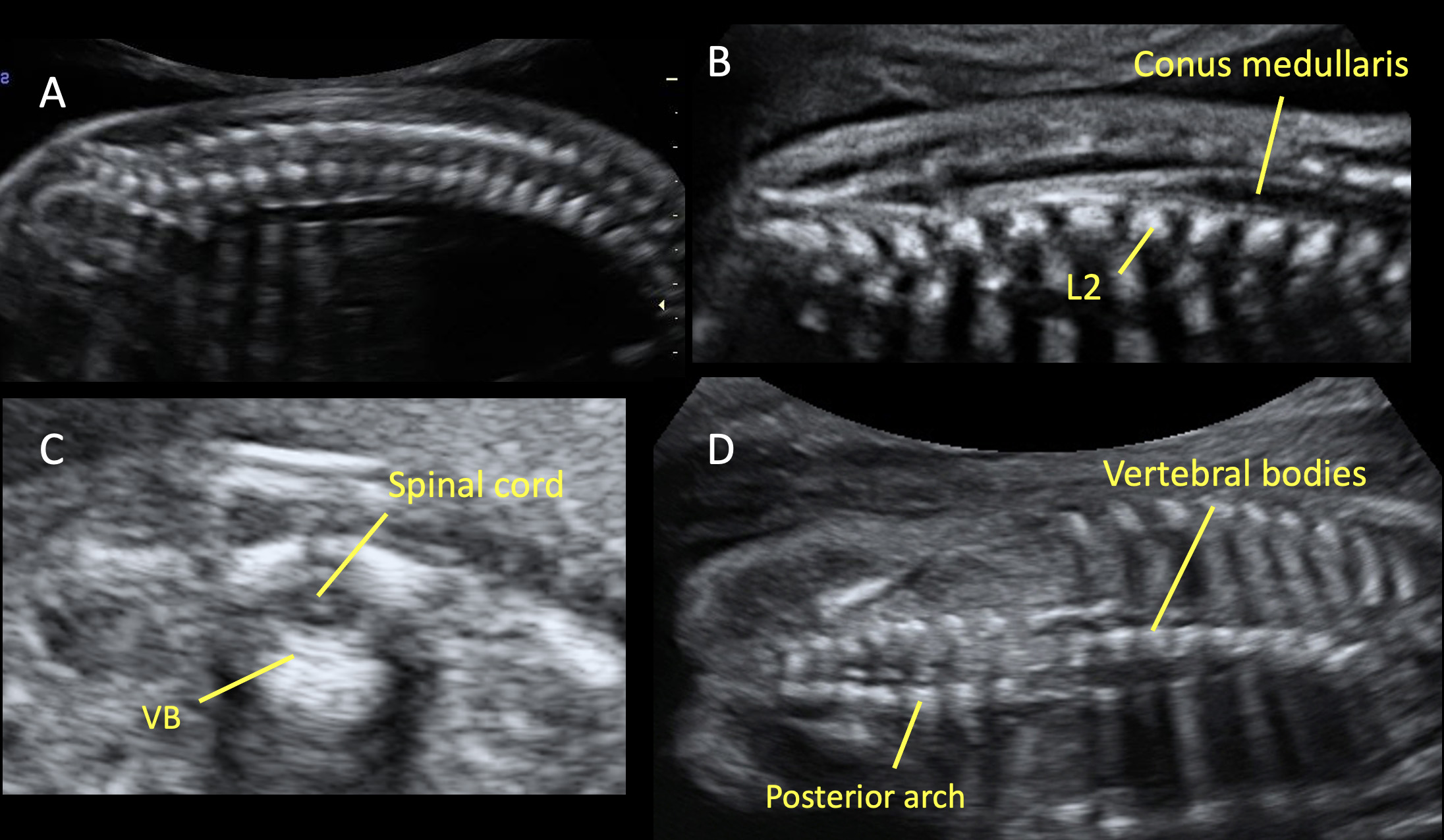 microphthalmia ultrasound