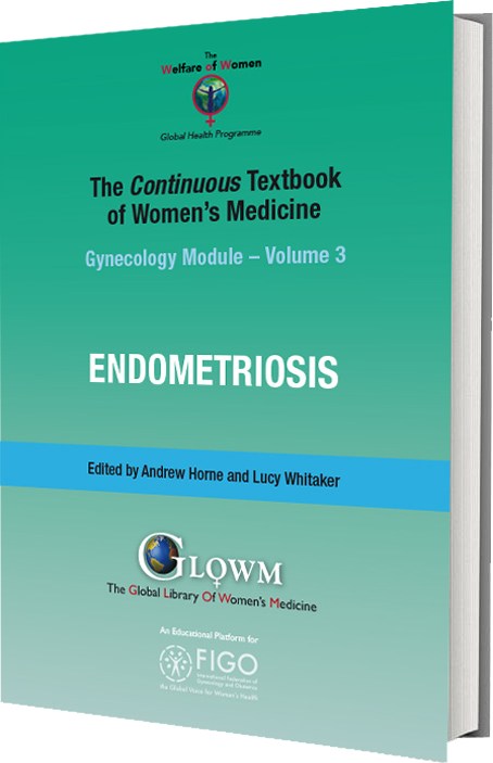 Menstruating primary umbilicus cutaneous endometriosis: A case report and  review of literature